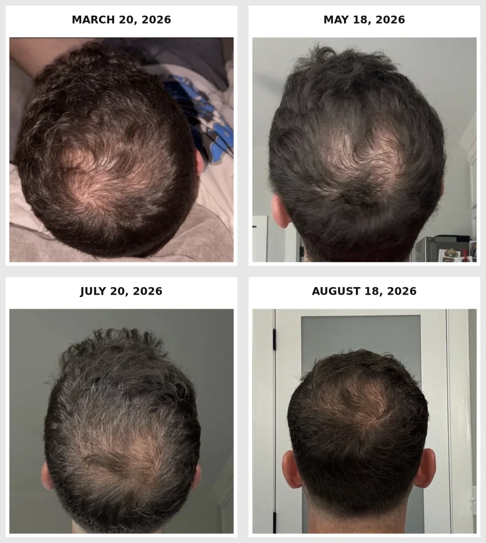 Progression of hair regrowth